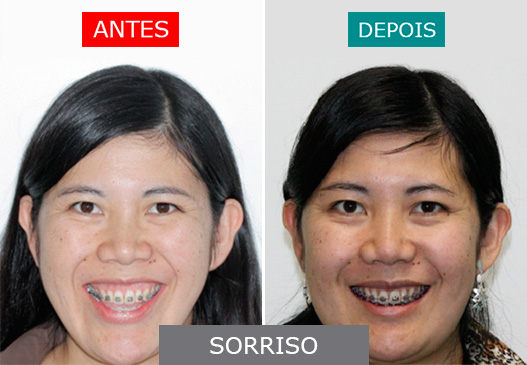 Caso 01_Sorriso