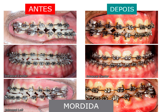 Caso 3 - Mordida