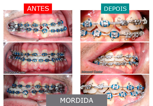 Caso 4 - Mordida