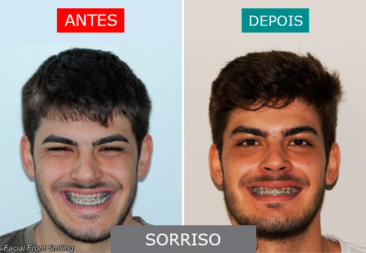 Caso 3 - Sorriso