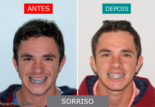 Caso 4 - Sorriso