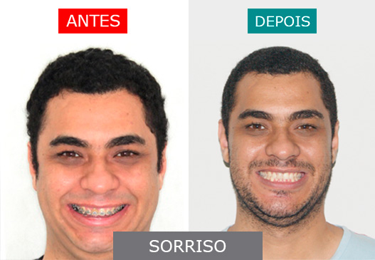 Caso 2 - Sorriso