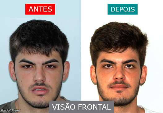 Caso 3 - Visão Frontal