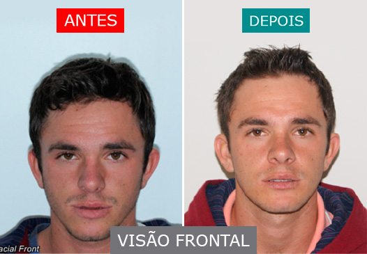 \Caso 4 - Visão Frontal