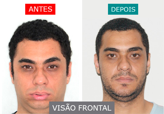 Caso 2 - Visão Frontal