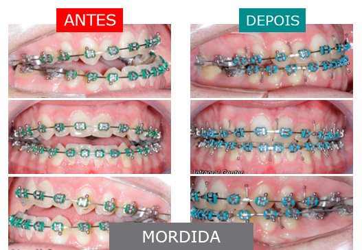 caso 8 - mordida