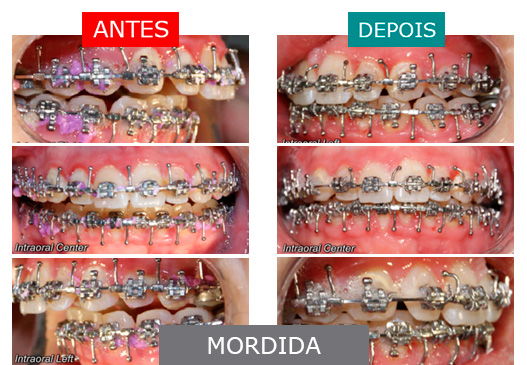 caso 9 - mordida