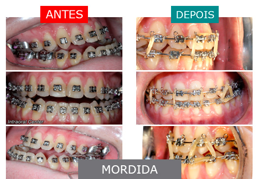 caso 12 - mordida