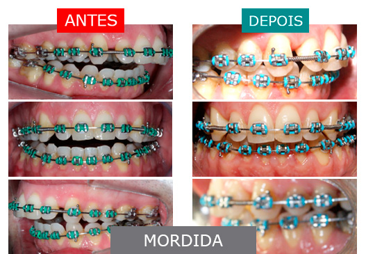 caso 13 - mordida