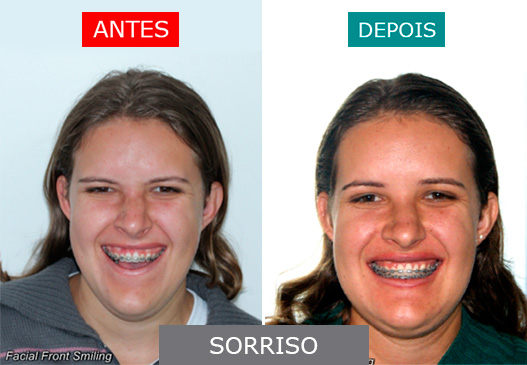 caso 6 - sorriso