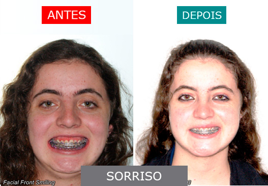 caso 9 - sorriso