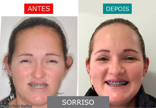 caso 11 - sorriso