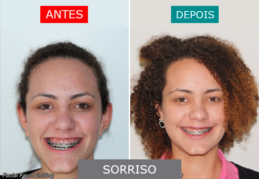 caso 05 - sorriso