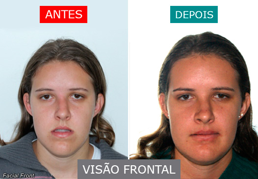 caso 06 - visão frontal