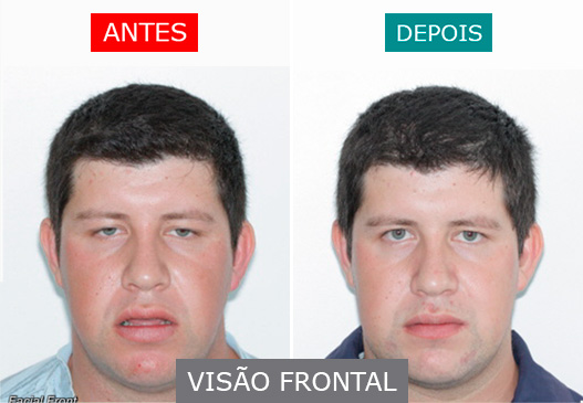 caso 8 - visão frontal