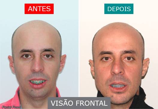 caso 13 - visão frontal