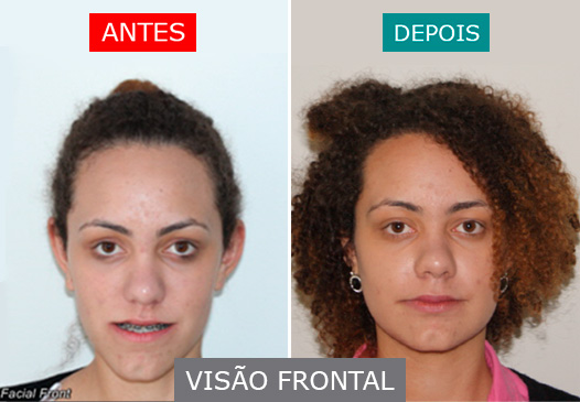 Caso 05 - visão frontal